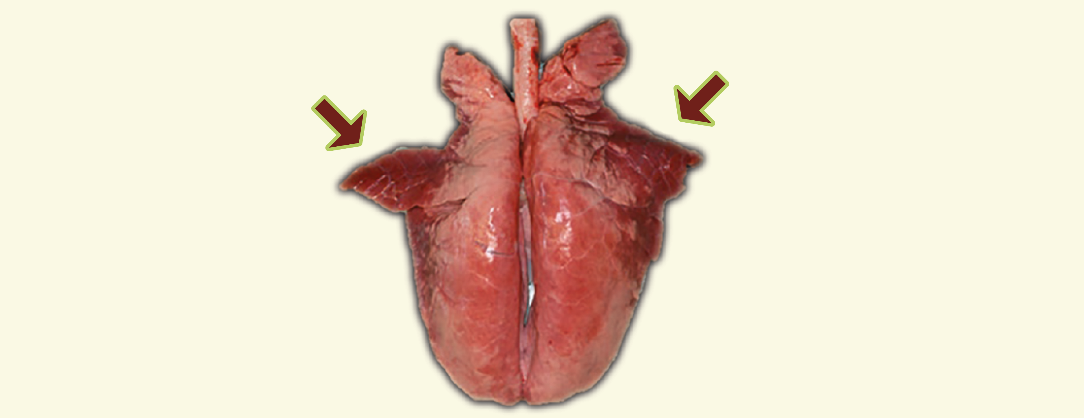 pulmon lesion