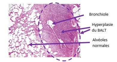tissu lymphoide péri bronchique